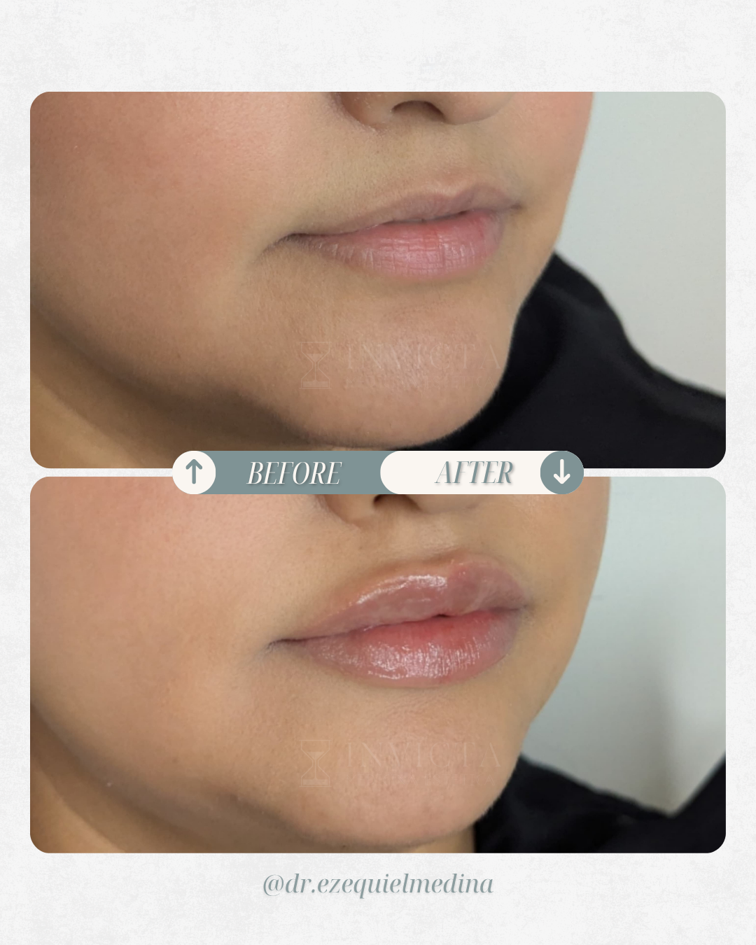 Antes y después — Armonización Facial