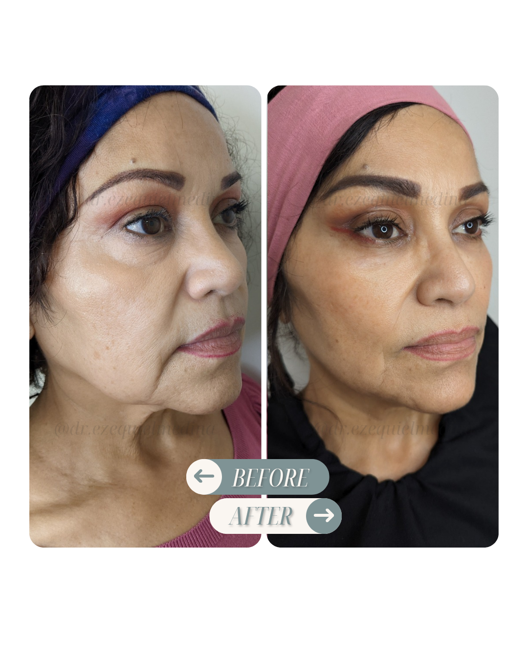 Antes y después — Bioestimulación